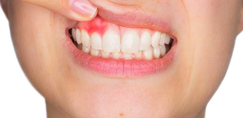 Health News: Gum disease linked to Alzheimer’s