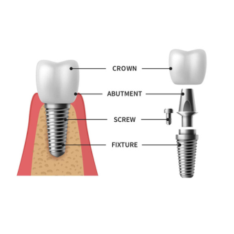 Frequently Asked Questions About Dental Implants